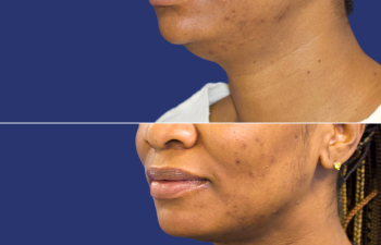 41 year-old before and 3 weeks after neck liposuction