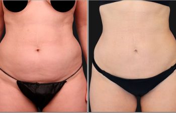 before and after liposuction procedure