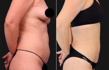 before and after liposuction procedure