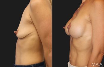 44 year-old patient before and 5 months after breast augmentation and lift