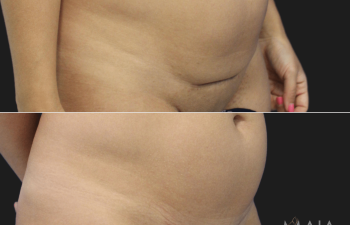 41 year-old patient before and 3.5 months after C-Section Scar Revision