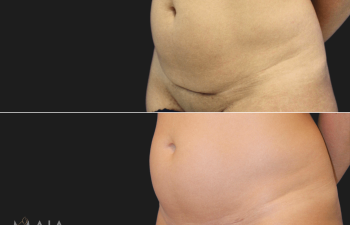 41 year-old patient before and 3.5 months after C-Section Scar Revision