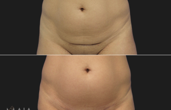 41 year-old patient before and 3.5 months after C-Section Scar Revision