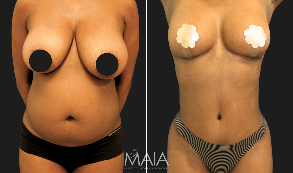 before and after Tummy Tuck; Liposuction; Breast Reduction