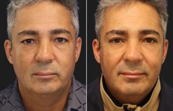 49 year-old male before and after an upper eyelid lift