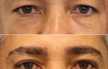 49 year-old male before and after an upper eyelid lift