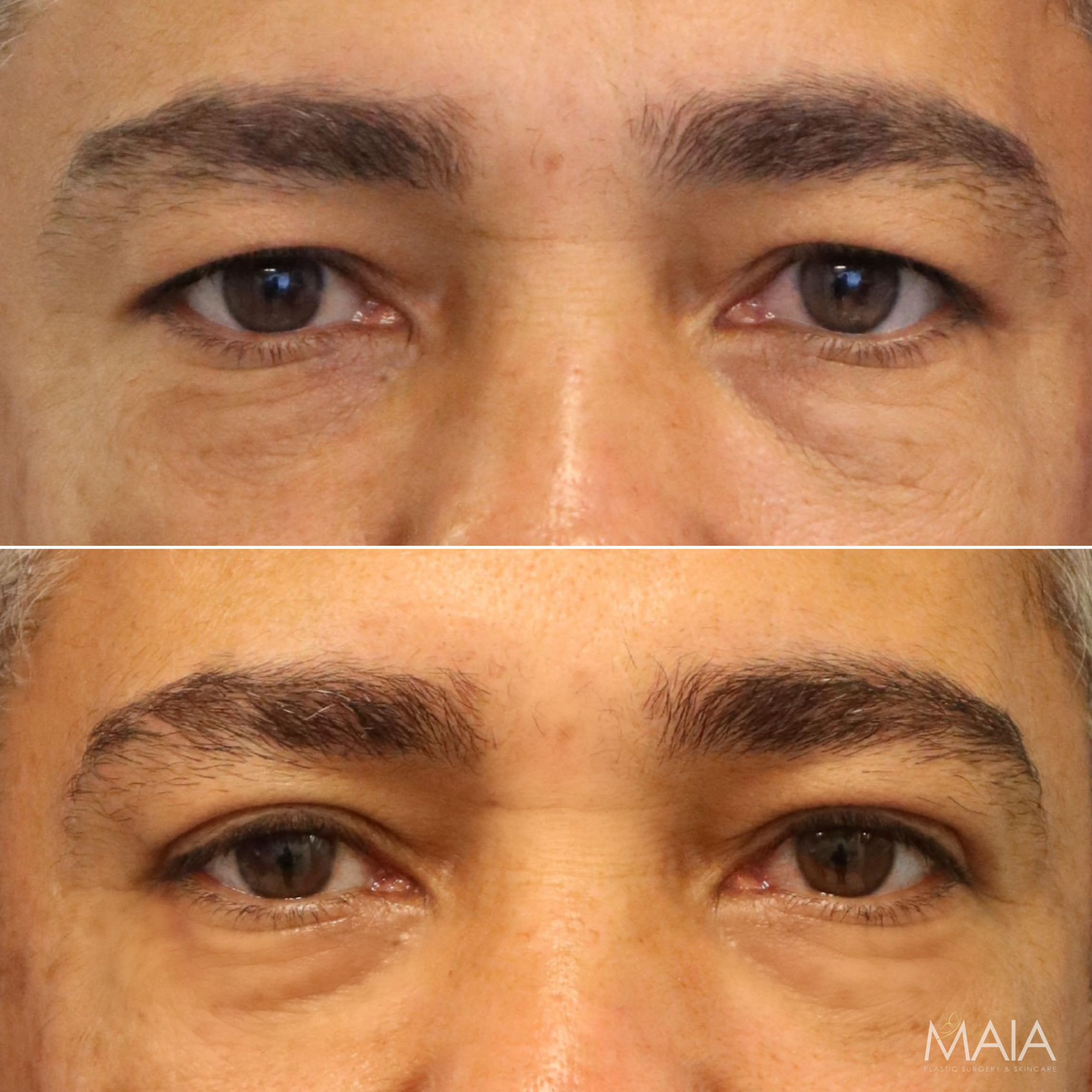 49 year-old male before and after an upper eyelid lift