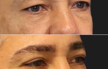 49 year-old male before and after an upper eyelid lift