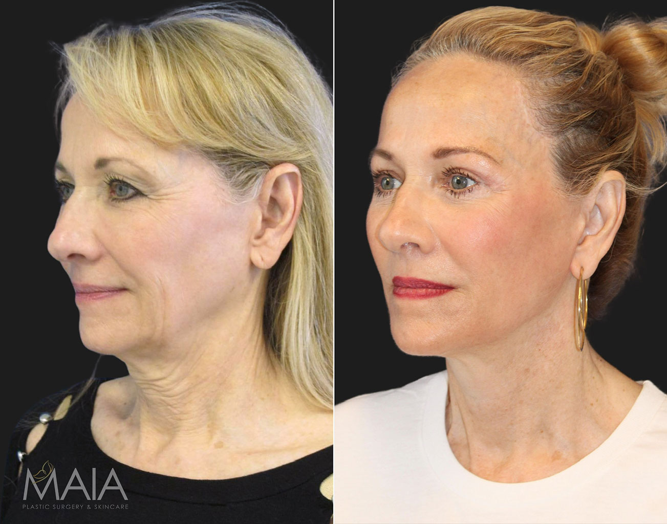 Before and 1 year after comprehensive facial rejuvenation