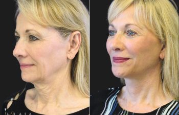 Before and 4 months after comprehensive facial rejuvenation