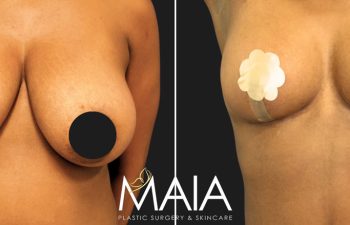 49 year-old patient before and 4 months after a tummy tuck, flanks liposuction, and a breast reduction