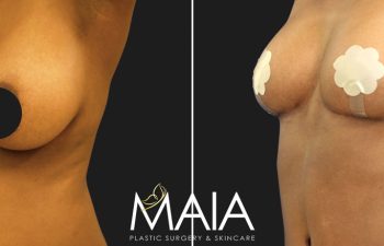 49 year-old patient before and 4 months after a tummy tuck, flanks liposuction, and a breast reduction