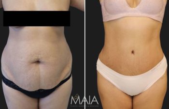 Fotografía de antes y después del abdomen de una persona que muestra los resultados de un procedimiento cosmético. La imagen de la izquierda muestra el abdomen antes del procedimiento y la imagen de la derecha muestra el abdomen después.