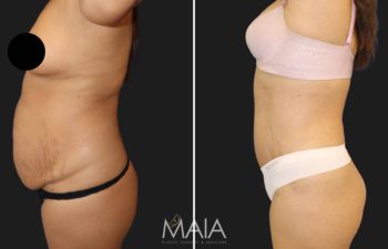 before and after tummy tuck and liposuction procedure