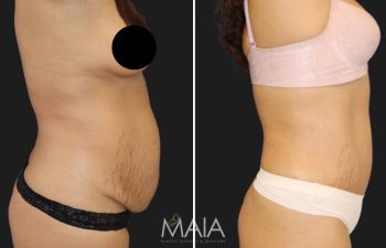 before and after tummy tuck and liposuction procedure