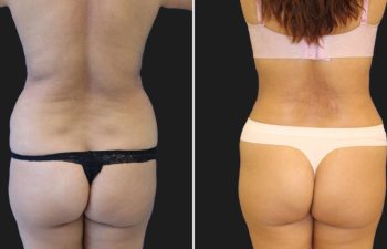 before and after tummy tuck and liposuction procedure