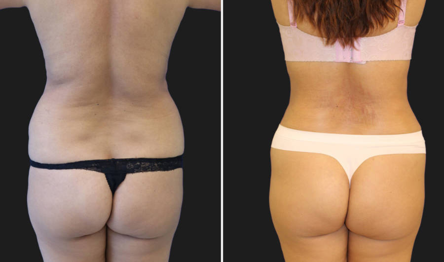 before and after tummy tuck and liposuction procedure