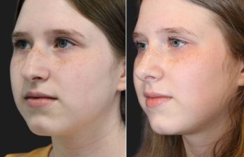 14 year old before and 1 month after rhinoplasty