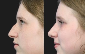 14 year old before and 1 month after rhinoplasty
