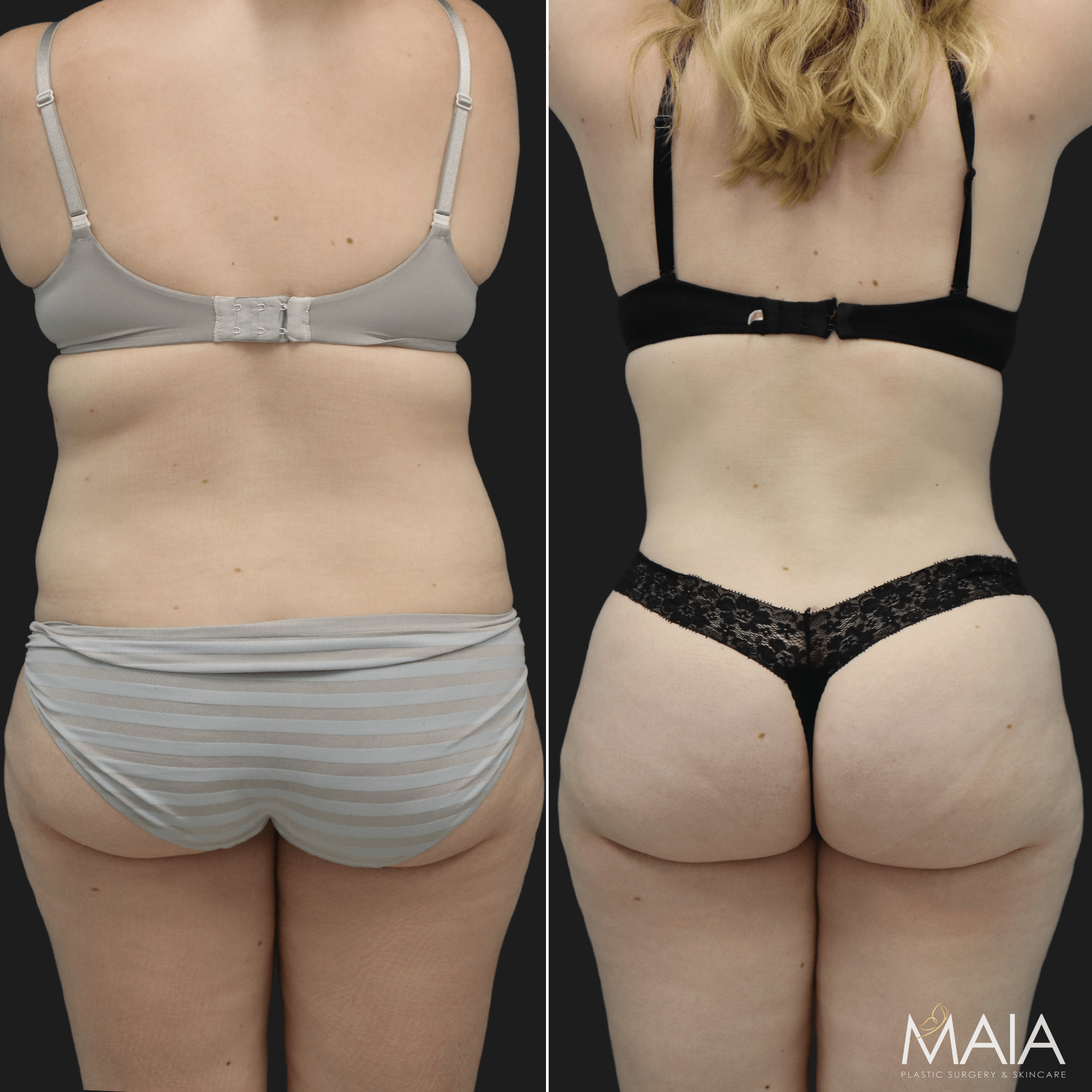 24 year-old patient before and after liposuction of abdomen, back, and flanks