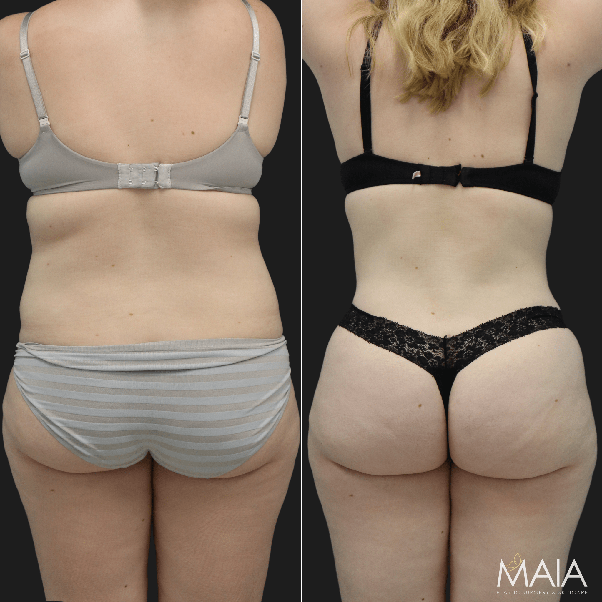 Liposuction of Flanks Before and After 3804