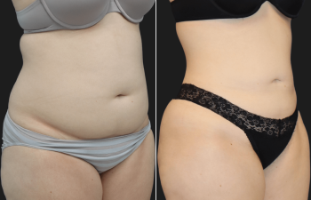 24 year-old patient before and after liposuction of abdomen, back, and flanks