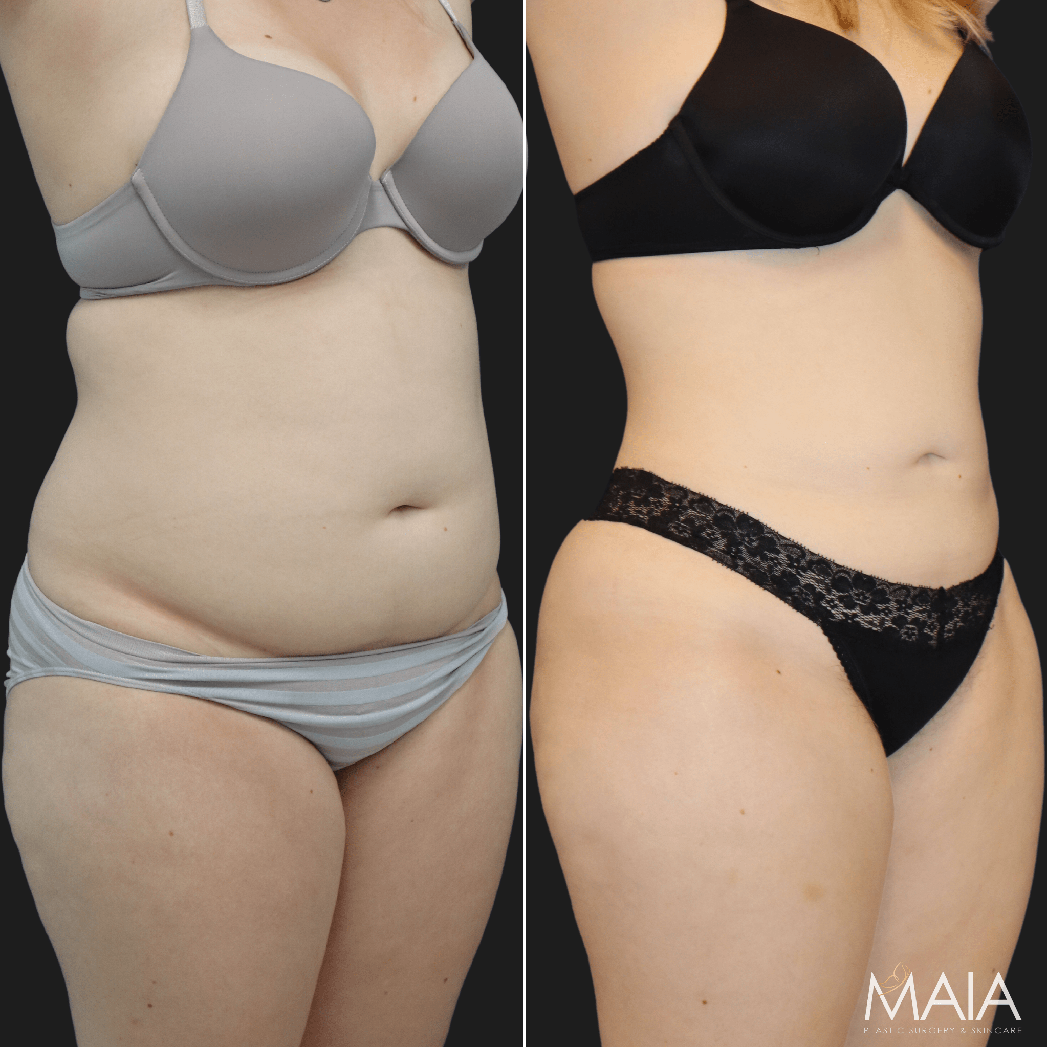 🥇 Liposuction  Maia Plastic Surgery