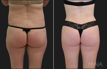 32 year-old before and 3 months after a tummy tuck and liposuction of the flanks, lower back, and outer thighs