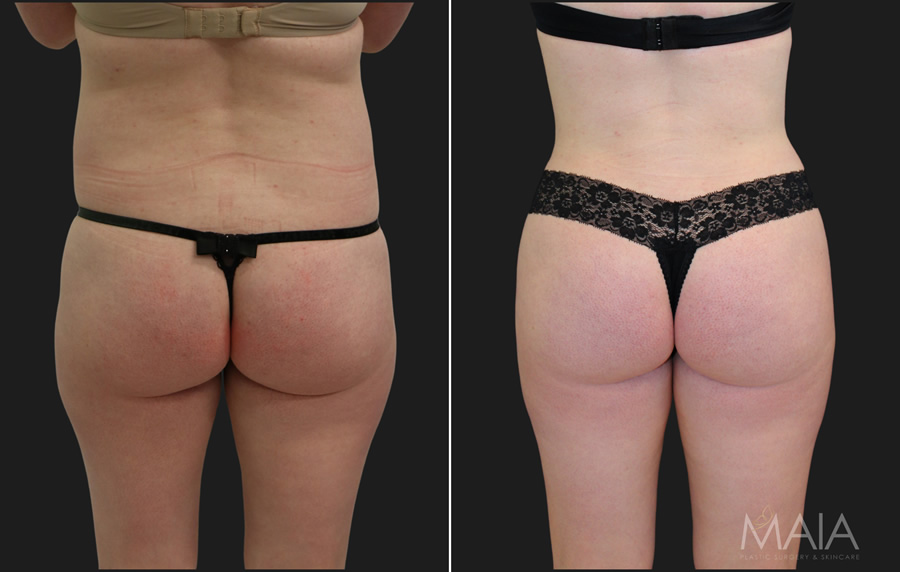 32 year-old before and 3 months after a tummy tuck and liposuction of the flanks, lower back, and outer thighs