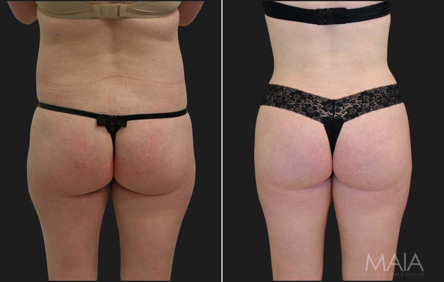 Upper and Lower Abdomen and Flank Liposuction, Inner and Outer Thigh  Liposuction with Fat Transfer to Buttocks - Terrell Clinic