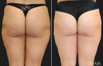 33 year old female before and 6 months after liposuction to the outer thighs