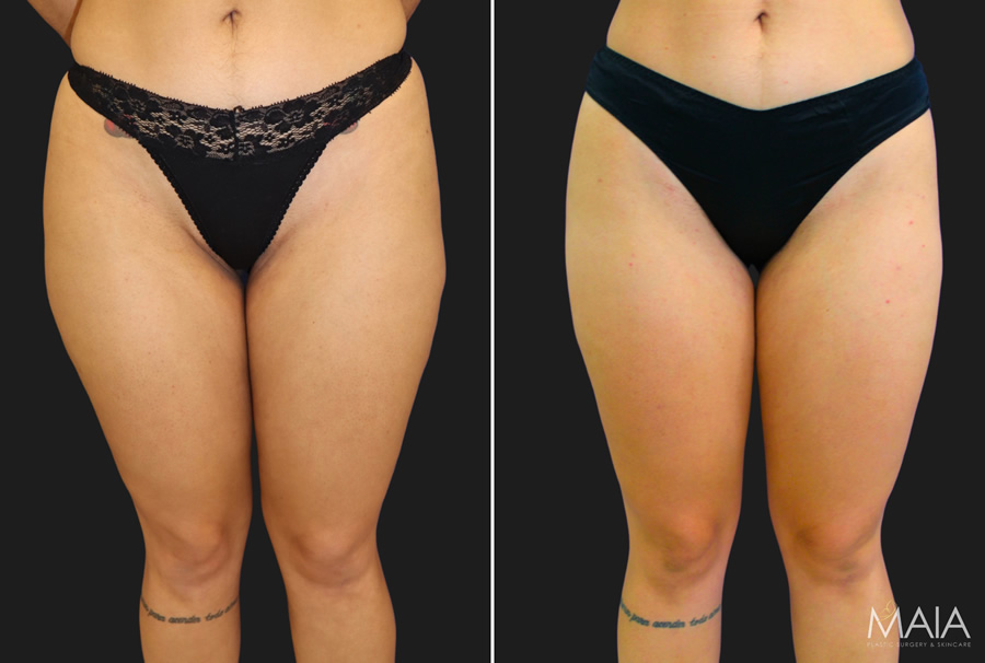 33 year old female before and 6 months after liposuction to the outer thighs