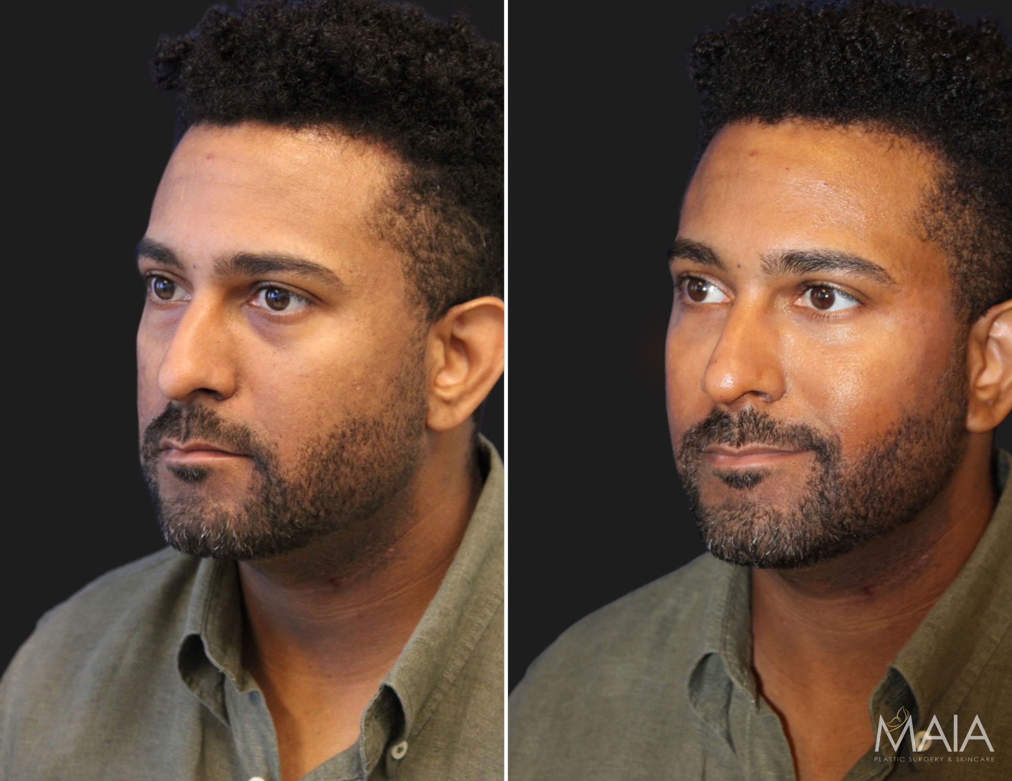 35 year-old male before and immediately after cheek filler, under-eye filler (tear trough), and non-surgical rhinoplasty