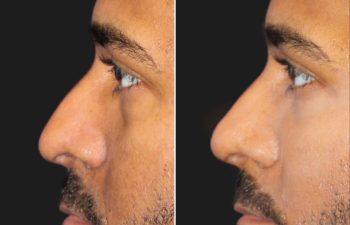 35 year-old male before and immediately after cheek filler, under-eye filler (tear trough), and non-surgical rhinoplasty