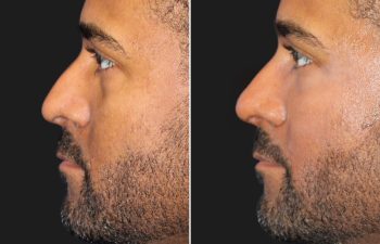 35 year-old male before and immediately after cheek filler, under-eye filler (tear trough), and non-surgical rhinoplasty