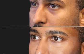 35 year-old male before and immediately after cheek filler, under-eye filler (tear trough), and non-surgical rhinoplasty