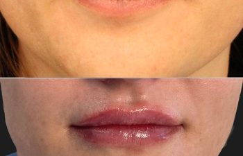 38 year-old before and immediately after lip fillers
