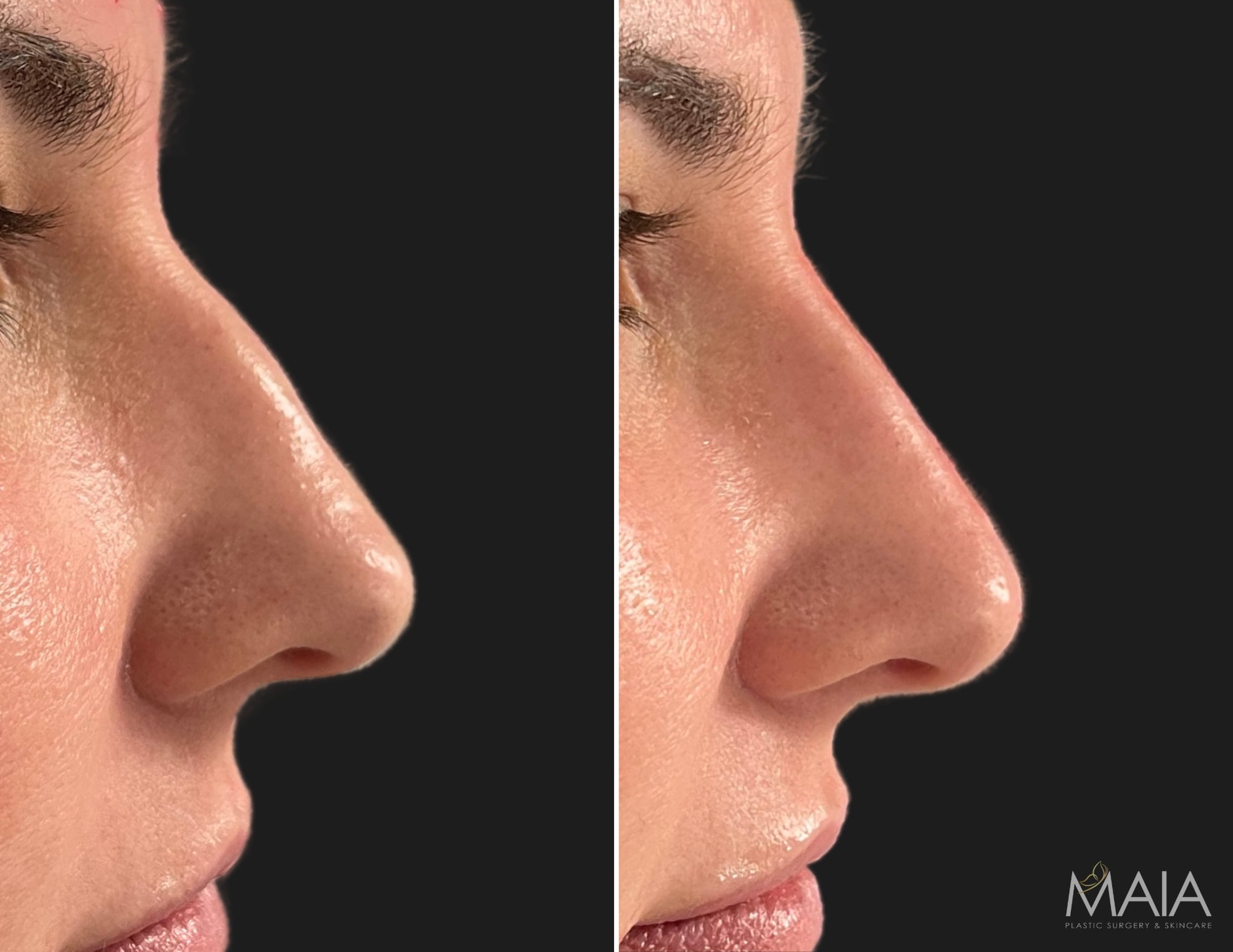 38 year-old female before and immediately after non-surgical rhinoplasty
