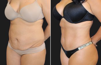 39 year-old mother of 2 before and 5 months after a tummy tuck