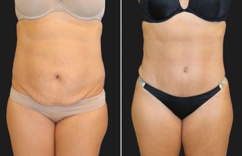 39 year-old mother of 2 before and 5 months after a tummy tuck