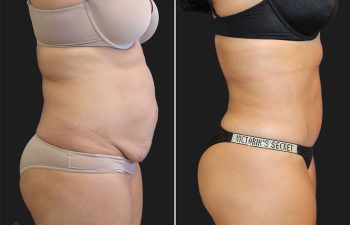 Comparación lado a lado de una persona en ropa interior antes y después de un procedimiento cosmético abdominal, que muestra una reducción significativa de la grasa abdominal y una mejora del contorno corporal.