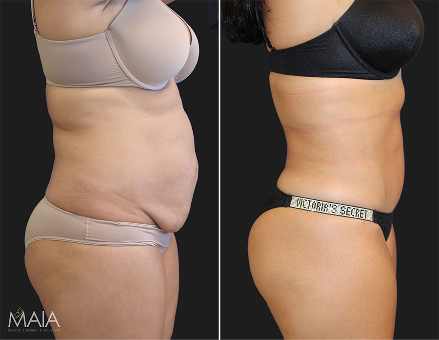 39 year-old mother of 2 before and 5 months after a tummy tuck