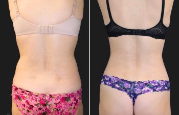 41 year-old mother of one before and after liposuction of the abdomen and flanks