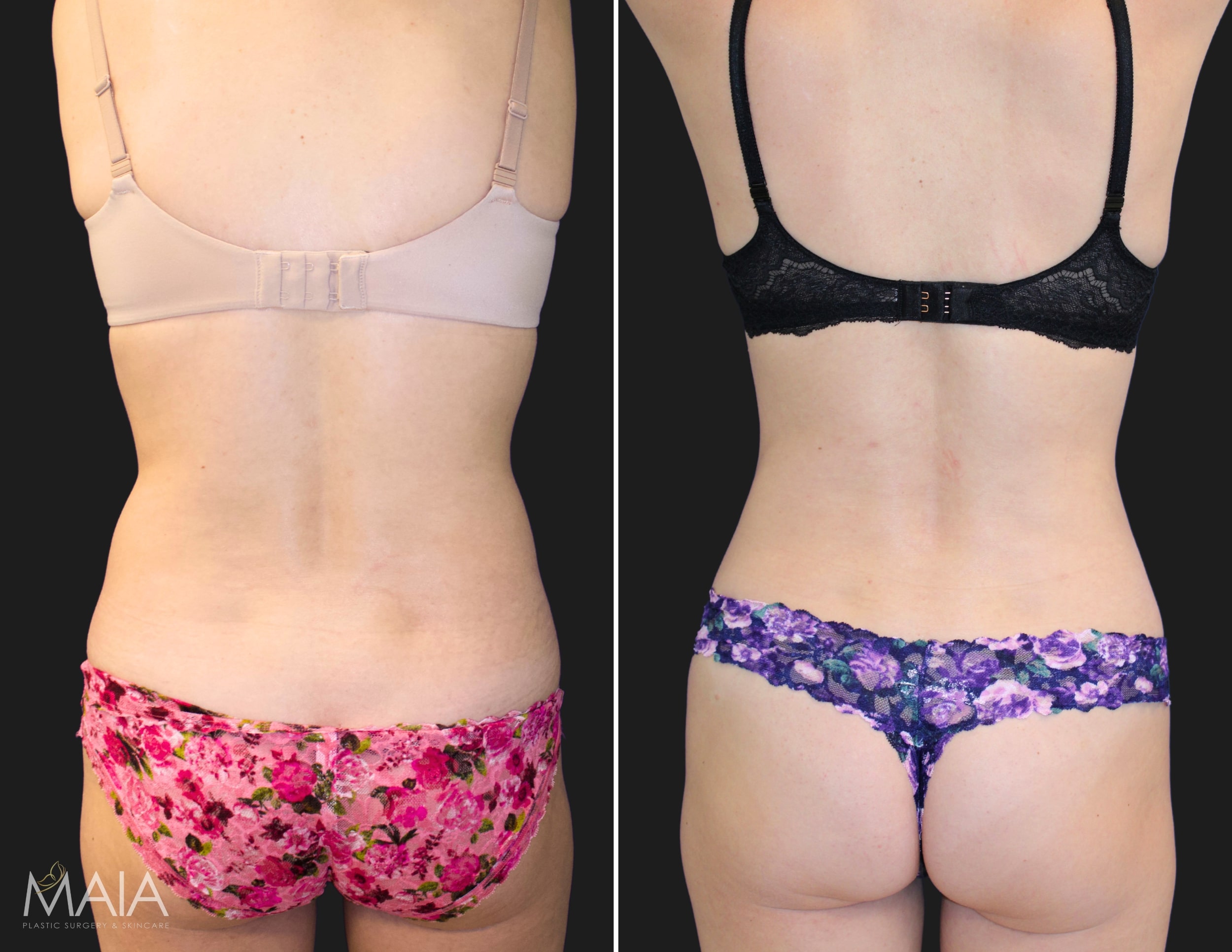 Liposuction of Back and Flanks - Associates in Plastic Surgery