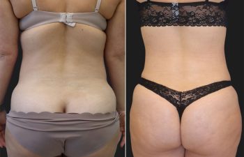 41 year-old patient before and after liposuction of abdomen, flanks, and bra rolls