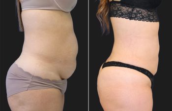 41 year-old patient before and after liposuction of abdomen, flanks, and bra rolls