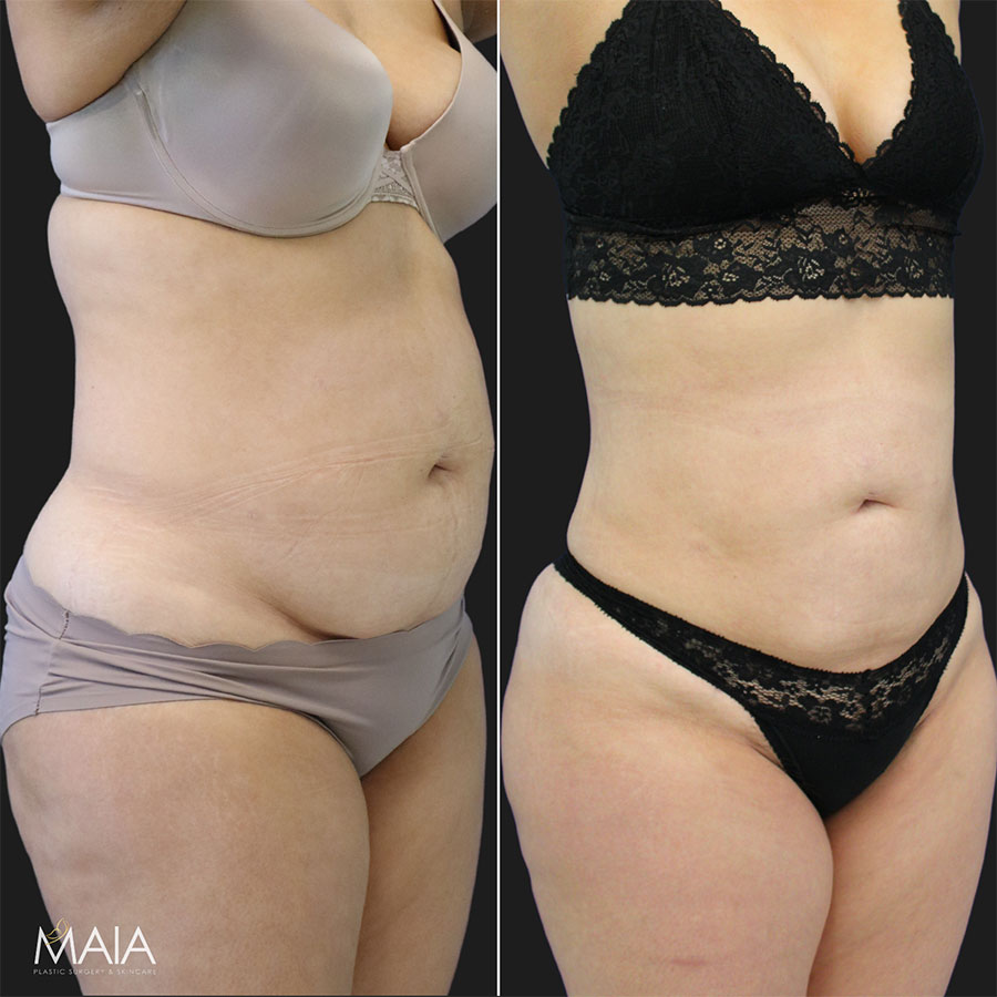 OR Snapshots - Abdominal and Flank Liposuction - Explore Plastic Surgery