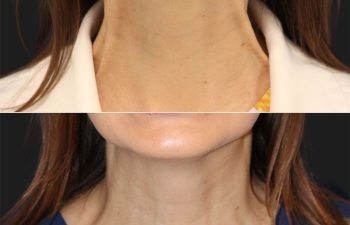 42-year-old before and after botox