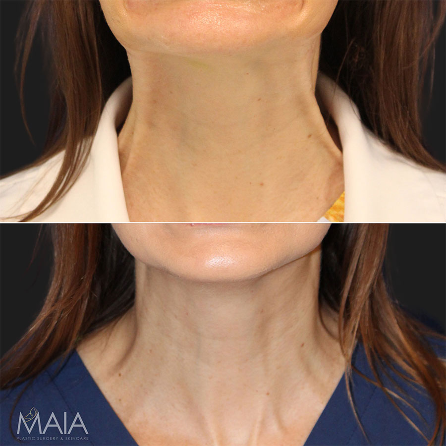 42-year-old before and after botox