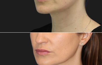 42 year-old before and after botox to the_ neck, eyebrows, forehead, glabella, and lip corners; Patient also underwent Morpheus8 microneedling, Jessner chemical peel, and medical-grade skincare treatment